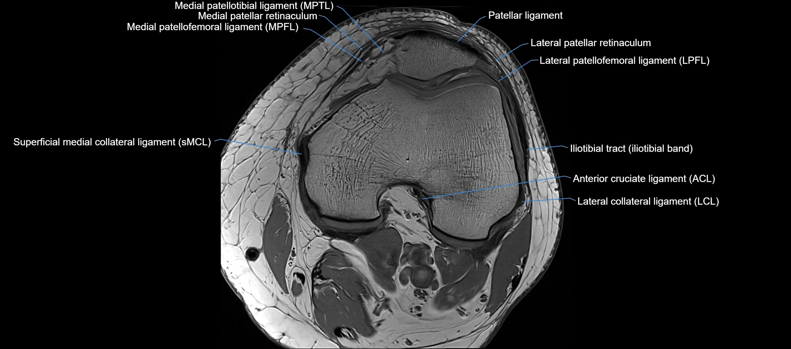 MRI Knee axial  ligaments cross sectional anatomy 3T  radiology  image-img-03001-00019.webp